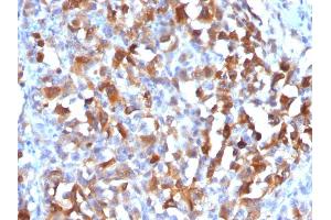 Formalin-fixed, paraffin-embedded human Melanoma stained with MART-1 Rabbit Polyclonal Antibody. (MLANA anticorps)
