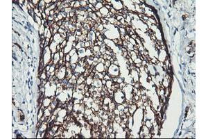 Immunohistochemical staining of paraffin-embedded Adenocarcinoma of Human breast tissue using anti-ERBB2 mouse monoclonal antibody. (ErbB2/Her2 anticorps  (AA 676-1255))