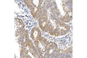 Immunohistochemistry of paraffin-embedded human colon carcinoma using SRP72 Rabbit pAb (ABIN6134166, ABIN6148452, ABIN7101299 and ABIN7101300) at dilution of 1:100 (40x lens). (SRP72 anticorps)