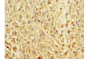 Immunohistochemistry of paraffin-embedded human melanoma using ABIN7151990 at dilution of 1:100