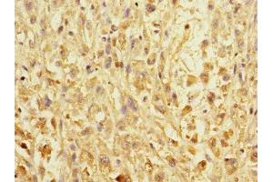 Immunohistochemistry of paraffin-embedded human melanoma using ABIN7151990 at dilution of 1:100 (ERBB2IP anticorps  (AA 1193-1412))