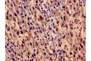 Immunocytochemistry analysis of human liver cancer using ABIN7151520 at dilution of 1:100 (EVC anticorps  (AA 493-602))