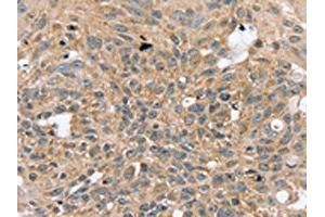 The image on the left is immunohistochemistry of paraffin-embedded Human breast cancer tissue using ABIN7130823(RASGEF1A Antibody) at dilution 1/20, on the right is treated with fusion protein. (RASGEF1A anticorps)