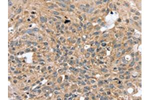 The image on the left is immunohistochemistry of paraffin-embedded Human breast cancer tissue using ABIN7130823(RASGEF1A Antibody) at dilution 1/20, on the right is treated with fusion protein.