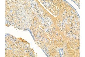 CHL1 Antibody at 1/100 staining Human ovarian cancer and adjacent normal tissues by IHC-P.