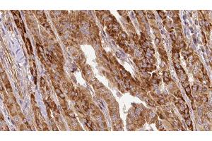 ABIN6267124 at 1/100 staining Human thyroid cancer tissue by IHC-P. (LIPE anticorps  (pSer563))