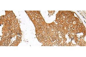Immunohistochemistry of paraffin-embedded Human colorectal cancer tissue using ZBTB8A Polyclonal Antibody at dilution of 1:100(x200) (ZBTB8A anticorps)