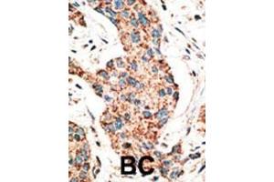 Formalin-fixed and paraffin-embedded human cancer tissue reacted with the primary antibody, which was peroxidase-conjugated to the secondary antibody, followed by AEC staining.