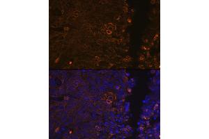 Immunofluorescence analysis of human cervix cancer using Cytokeratin 13 (KRT13) (KRT13) Rabbit mAb (ABIN7268089) at dilution of 1:100 (40x lens). (Cytokeratin 13 anticorps)
