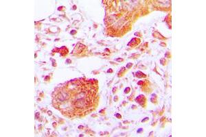 Immunohistochemical analysis of PLC gamma 1 (pY783) staining in human lung cancer formalin fixed paraffin embedded tissue section. (Phospholipase C gamma 1 anticorps  (pTyr783))
