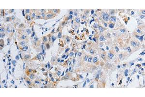 Immunohistochemistry of paraffin-embedded Human lung cancer tissue using GRIA3 Polyclonal Antibody at dilution 1:50 (Glutamate Receptor 3 anticorps)