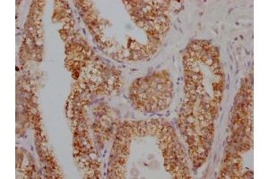 IHC image of ABIN7166043 diluted at 1:100 and staining in paraffin-embedded human prostate cancer performed on a Leica BondTM system. (S100A12 anticorps  (AA 2-91))