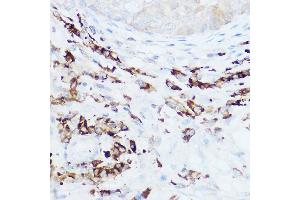 Immunohistochemistry of paraffin-embedded human breast cancer using NEDD9 Rabbit pAb (ABIN3023330, ABIN3023331, ABIN3023332 and ABIN6219606) at dilution of 1:100 (40x lens).