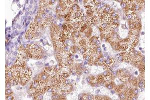 ABIN6267633 at 1/100 staining human liver carcinoma tissue sections by IHC-P. (PAK1 anticorps  (pThr212))