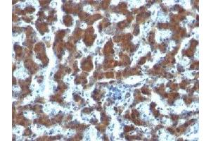 IHC testing of FFPE human hepatocellular carcinoma and RBP antibody (clone G4E4). (RBP1 anticorps  (AA 74-182))