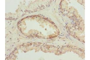 Immunohistochemistry of paraffin-embedded human prostate cancer using ABIN7173695 at dilution of 1:100