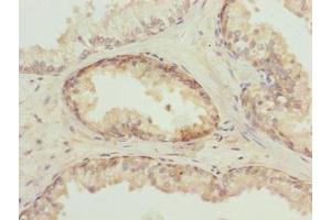Immunohistochemistry of paraffin-embedded human prostate cancer using ABIN7173695 at dilution of 1:100 (TUBb6 anticorps  (AA 1-446))