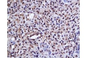 Formalin-fixed and paraffin embedded human endometrium tissue labeled with Anti-phospho-AKT/PKB(Ser473) Polyclonal Antibody, Unconjugated  at 1:200, followed by conjugation to the secondary antibody and DAB staining (AKT 1/2/3 anticorps  (pSer473))