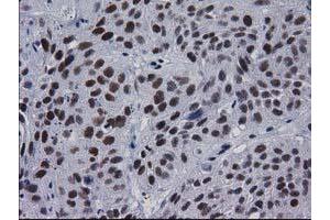 Immunohistochemical staining of paraffin-embedded Carcinoma of Human bladder tissue using anti-MYD88 mouse monoclonal antibody. (MYD88 anticorps)