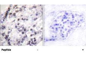 Immunohistochemistry analysis of paraffin-embedded human breast carcinoma tissue using HNRNPC polyclonal antibody . (HNRNPC anticorps  (Ser260))