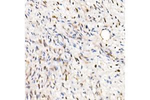 Immunohistochemistry of paraffin-embedded Human epithelioid sarcoma (ini-1 deletion) using SM/SNF5 Rabbit pAb  at dilution of 1:250 (40x lens).