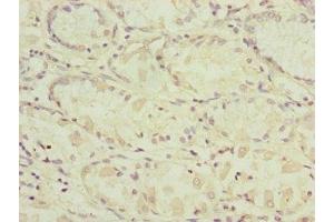 Immunohistochemistry of paraffin-embedded human gastric cancer using ABIN7164324 at dilution of 1:100