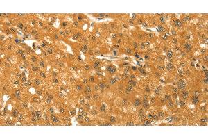 Immunohistochemistry of paraffin-embedded Human liver cancer using TM7SF2 Polyclonal Antibody at dilution of 1:30