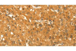 Immunohistochemistry of paraffin-embedded Human liver cancer using TM7SF2 Polyclonal Antibody at dilution of 1:30 (TM7SF2 anticorps)