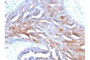 Formalin-fixed, paraffin-embedded human Ovarian Carcinoma stained with TAG-72 Mouse Monoclonal Antibody (B72. (TAG-72 / CA72.4 anticorps)