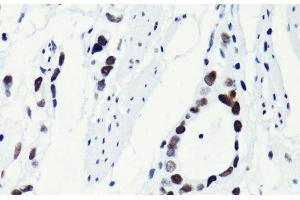 Immunohistochemistry of paraffin-embedded Human gastric cancer using Acetyl-Histone H2B-K5 Polyclonal Antibody at dilution of 1:100 (40x lens).