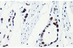 Immunohistochemistry of paraffin-embedded Human gastric cancer using Acetyl-Histone H2B-K5 Polyclonal Antibody at dilution of 1:100 (40x lens). (Histone H2B anticorps  (acLys5))