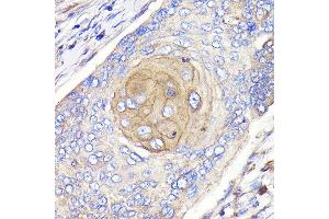 Immunohistochemistry of paraffin-embedded human esophageal cancer using FGFR3 Rabbit mAb (ABIN7267191) at dilution of 1:100 (40x lens).