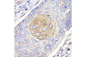 Immunohistochemistry of paraffin-embedded human esophageal cancer using FGFR3 Rabbit mAb (ABIN7267191) at dilution of 1:100 (40x lens). (FGFR3 anticorps)