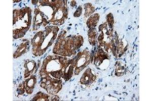 Immunohistochemical staining of paraffin-embedded Adenocarcinoma of ovary tissue using anti-RALBP1 mouse monoclonal antibody. (RALBP1 anticorps)