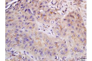 Formalin-fixed and paraffin embedded human laryngocarcinoma labeled with Anti-CYB5R4 Polyclonal Antibody, Unconjugated  at 1:200 followed by conjugation to the secondary antibody and DAB staining.