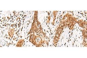 Immunohistochemistry of paraffin-embedded Human esophagus cancer tissue using DGCR6L Polyclonal Antibody at dilution of 1:65(x200) (DGCR6L anticorps)