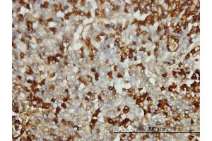 Immunoperoxidase of monoclonal antibody to FGG on formalin-fixed paraffin-embedded human hepatocellular carcinoma tissue.