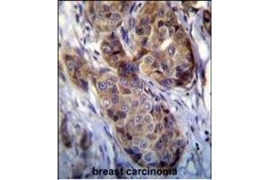 GEA12 antibody (N-term) (ABIN390104 and ABIN2840616) immunohistochemistry analysis in forlin fixed and paraffin embedded hun breast carcino followed by peroxidase conjugation of the secondary antibody and DAB staining. (MAGEA12 anticorps  (N-Term))