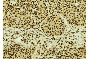 ABIN6274755 at 1/100 staining Human breast cancer tissue by IHC-P.