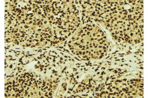 ABIN6274755 at 1/100 staining Human breast cancer tissue by IHC-P. (RPS3 anticorps  (Internal Region))