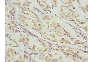 Immunohistochemistry of paraffin-embedded human gastric cancer using ABIN7156409 at dilution of 1:100 (Integrator Complex Subunit 14 (INTS14) (AA 231-518) anticorps)