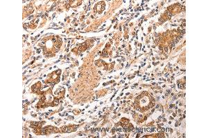 Immunohistochemistry of Human gastric cancer using CCL17 Polyclonal Antibody at dilution of 1:70 (CCL17 anticorps)