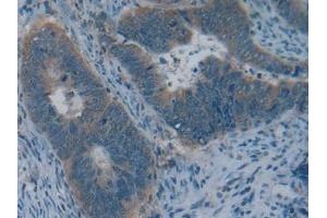 Detection of COL4a1 in Human Colorectal cancer Tissue using Polyclonal Antibody to Collagen Type IV Alpha 1 (COL4a1)