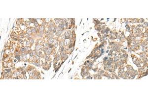 Immunohistochemistry of paraffin-embedded Human thyroid cancer tissue using COA7 Polyclonal Antibody at dilution of 1:55(x200) (C1orf163 anticorps)