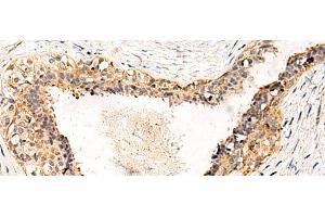 Immunohistochemistry of paraffin-embedded Human breast cancer tissue using GPR152 Polyclonal Antibody at dilution of 1:55(x200)