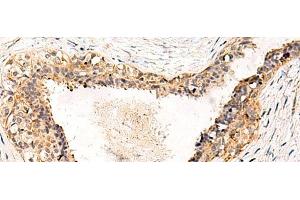 Immunohistochemistry of paraffin-embedded Human breast cancer tissue using GPR152 Polyclonal Antibody at dilution of 1:55(x200) (GPR152 anticorps)