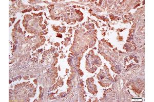 Formalin-fixed and paraffin embedded human lung carcinoma labeled with Anti-FPR1 Polyclonal Antibody, Unconjugated (ABIN742245) at 1:200 followed by conjugation to the secondary antibody and DAB staining