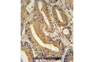 AP3S1 antibody (N-term) immunohistochemistry analysis in formalin fixed and paraffin embedded human colon carcinoma followed by peroxidase conjugation of the secondary antibody and DAB staining.