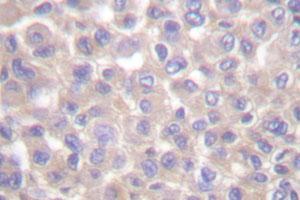 Immunohistochemical analysis of paraffin-embedded human breast cancer tissue using TRADD polyclonal antibody . (TRADD anticorps)