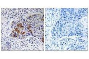 Immunohistochemistry analysis of paraffin-embedded human lung carcinoma tissue, using ADCY9 antibody. (ADCY9 anticorps  (N-Term))